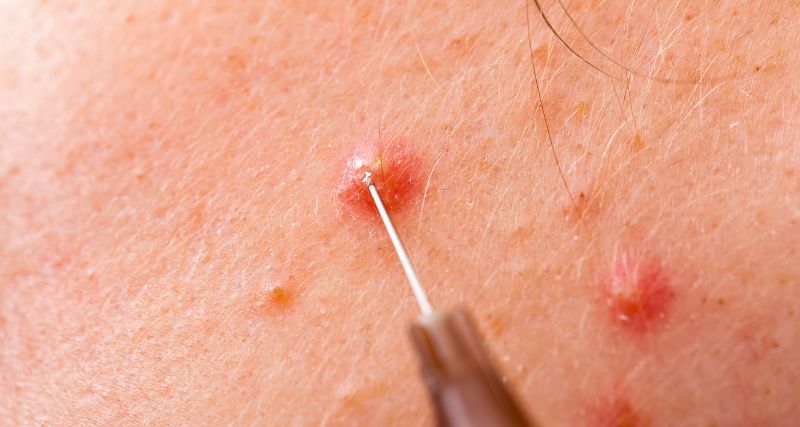 Curso tratamiento del ácne