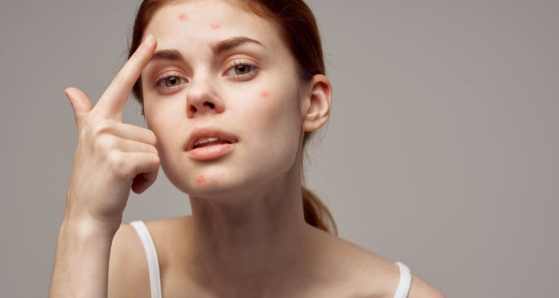 Curso tratamiento del ácne