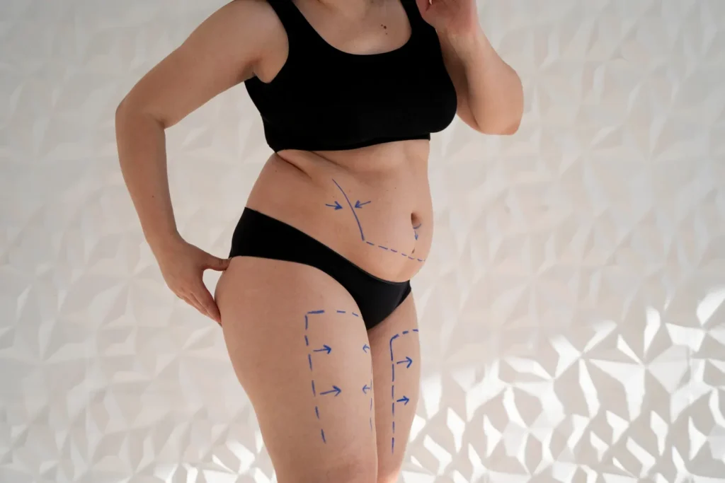Maestría en Cirugía de Contorno Corporal Liposucción Lipo HD y Lipoescultura 3