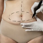 Maestría en Abdominoplastia y Cirugía Postbariátrica 1
