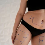 Maestría en Cirugía de Contorno Corporal Liposucción Lipo HD y Lipoescultura 1