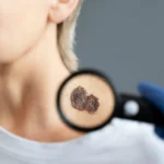 Maestría en Complicaciones Cutáneas por Estética Necrosis Granulomas e Infecciones 1