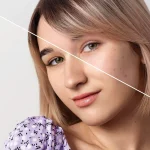 Maestría en Hiperpigmentaciones Melasma PIH y Tratamientos Combinados 1